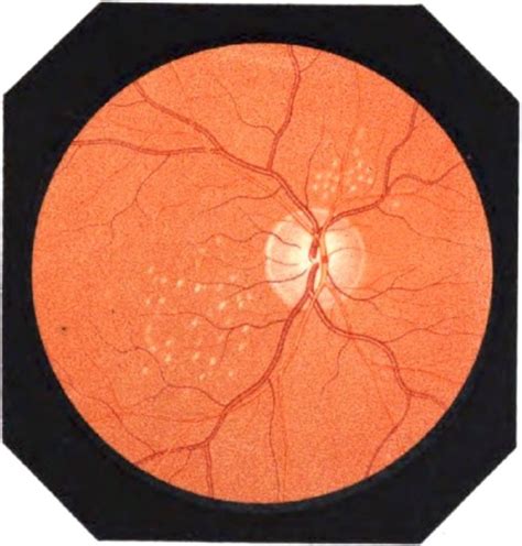 drusen mega|Elusive drusen and changing terminology of AMD .